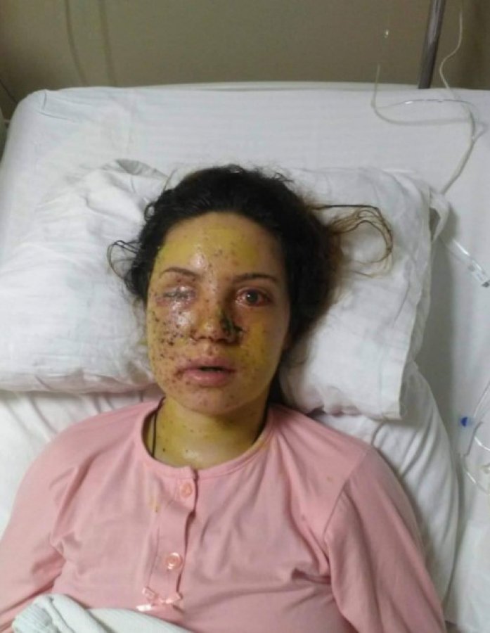 Eşi tarafından vurulan genç kadın gözünü kaybetti